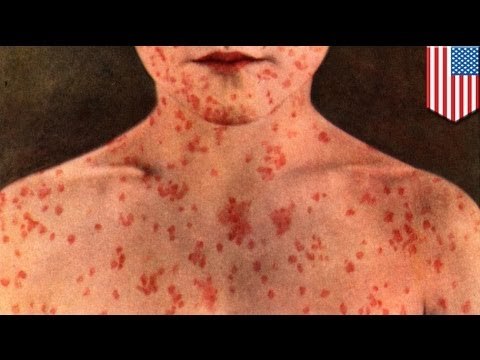 Oral measles drug: combat the infectious disease amid the anti-vaccination movement