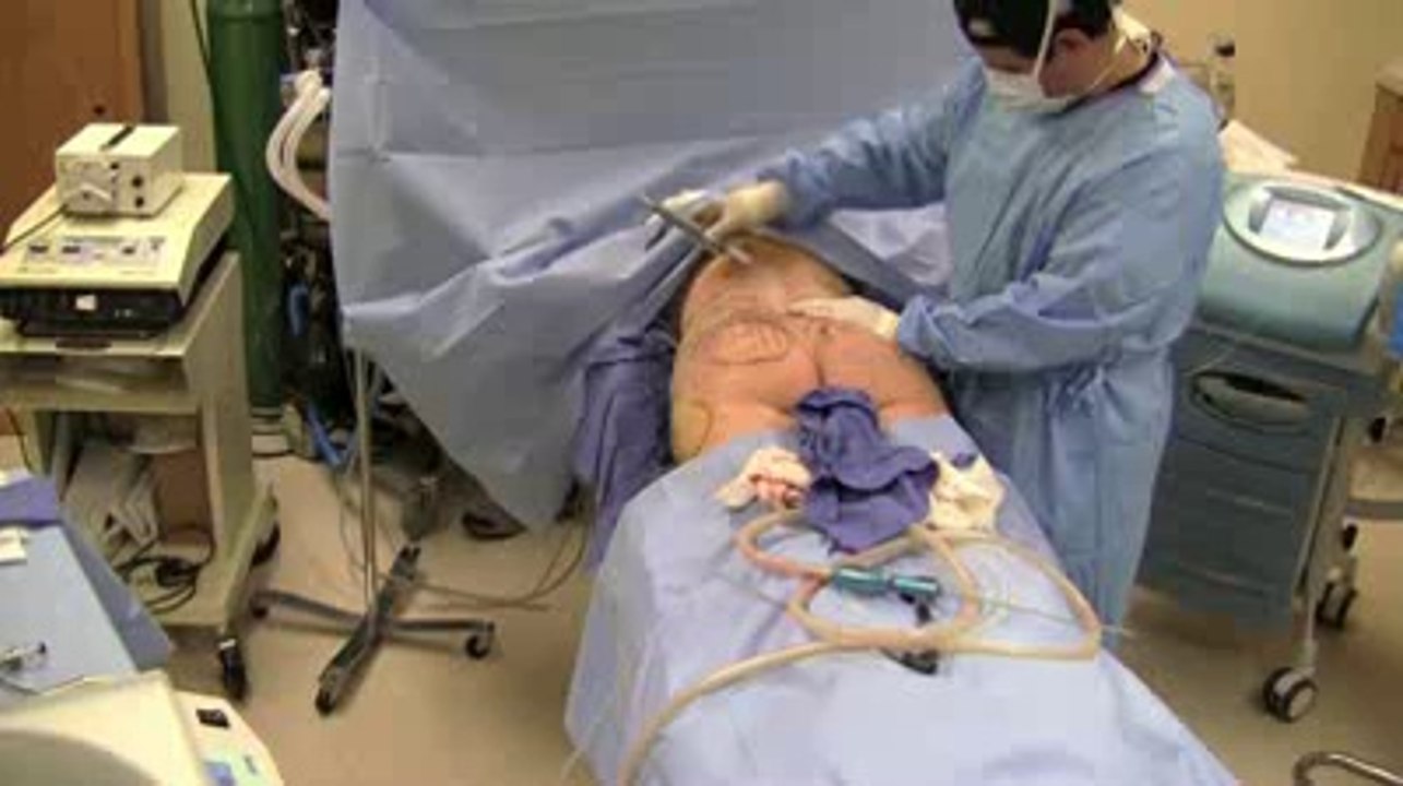 Liposuction by Dr. Jeff Angobaldo at Renaissance Plastic Surgery in Plano
