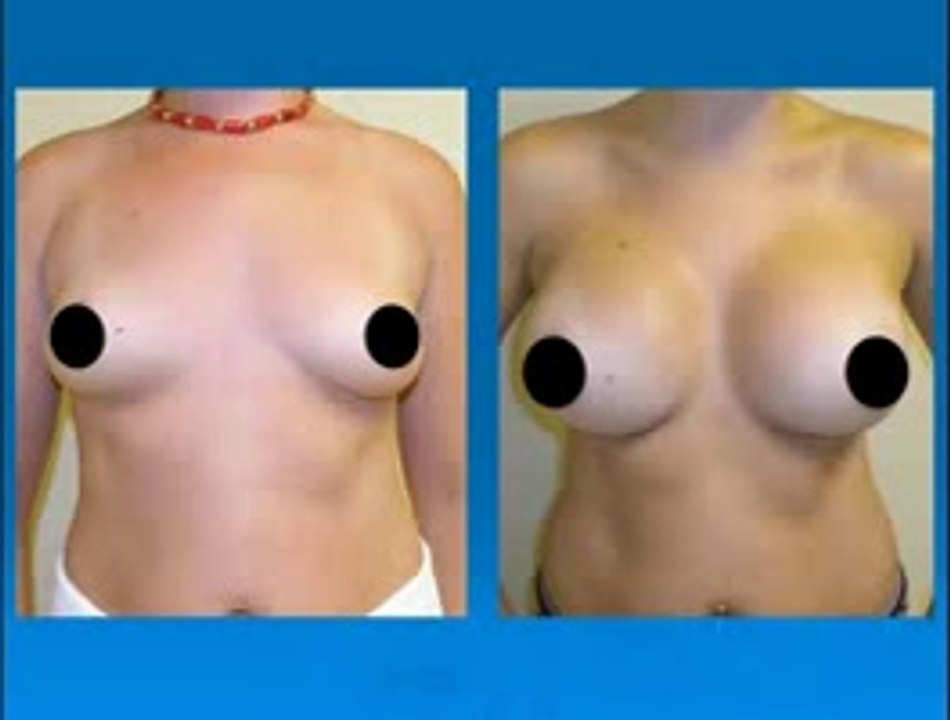 Breast Augmentation Procedure in Plano Texas