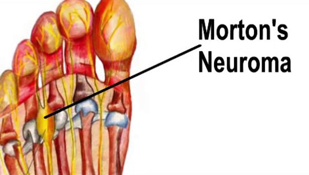 Hackensack, Teaneck and Maywood, NJ - Morton’s Neuroma - Podiatrist Diane Guadara