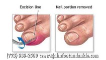 Niles, Chicago and Des Plaines, IL - Ingrown Toenails - Podiatrist Tae Jun Ahn (TJ), DPM