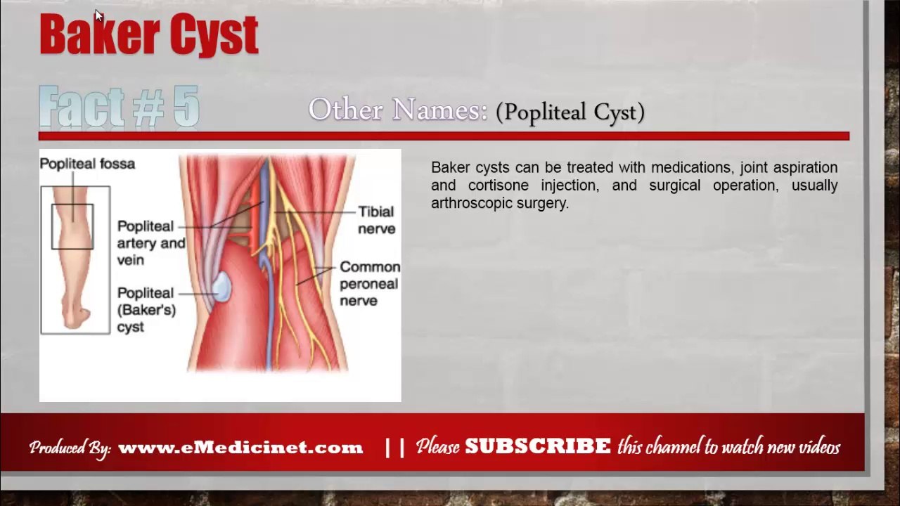 Baker Cyst