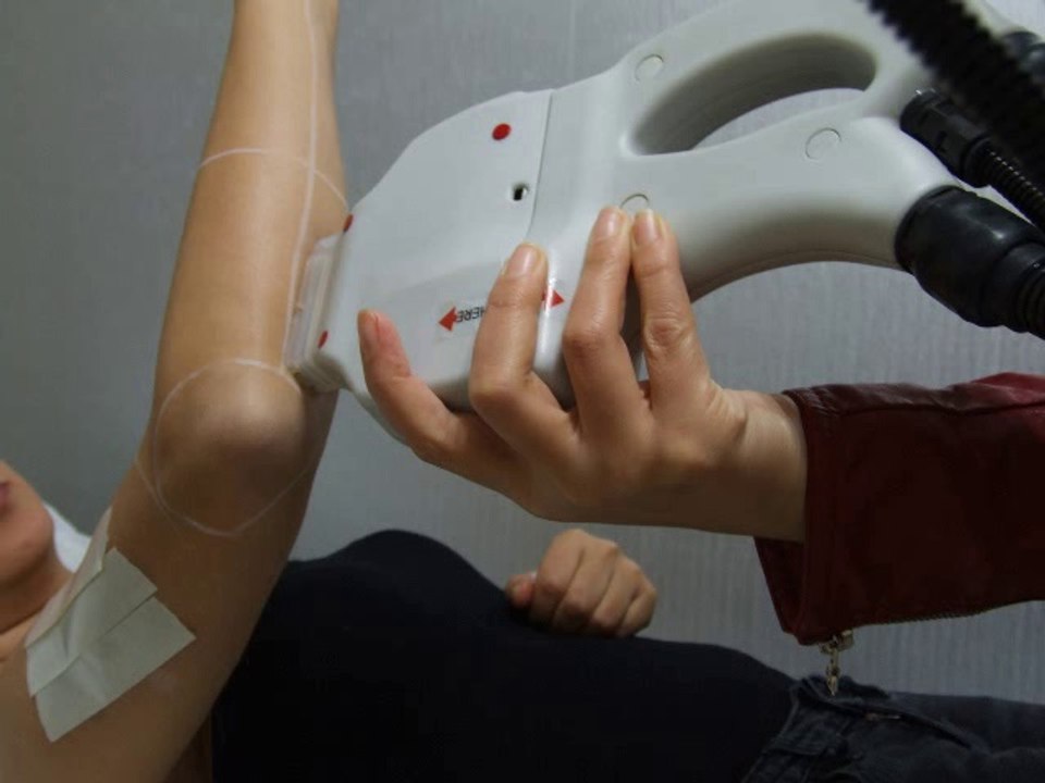 treatments: arm area