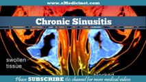 Sinusitis - Explained