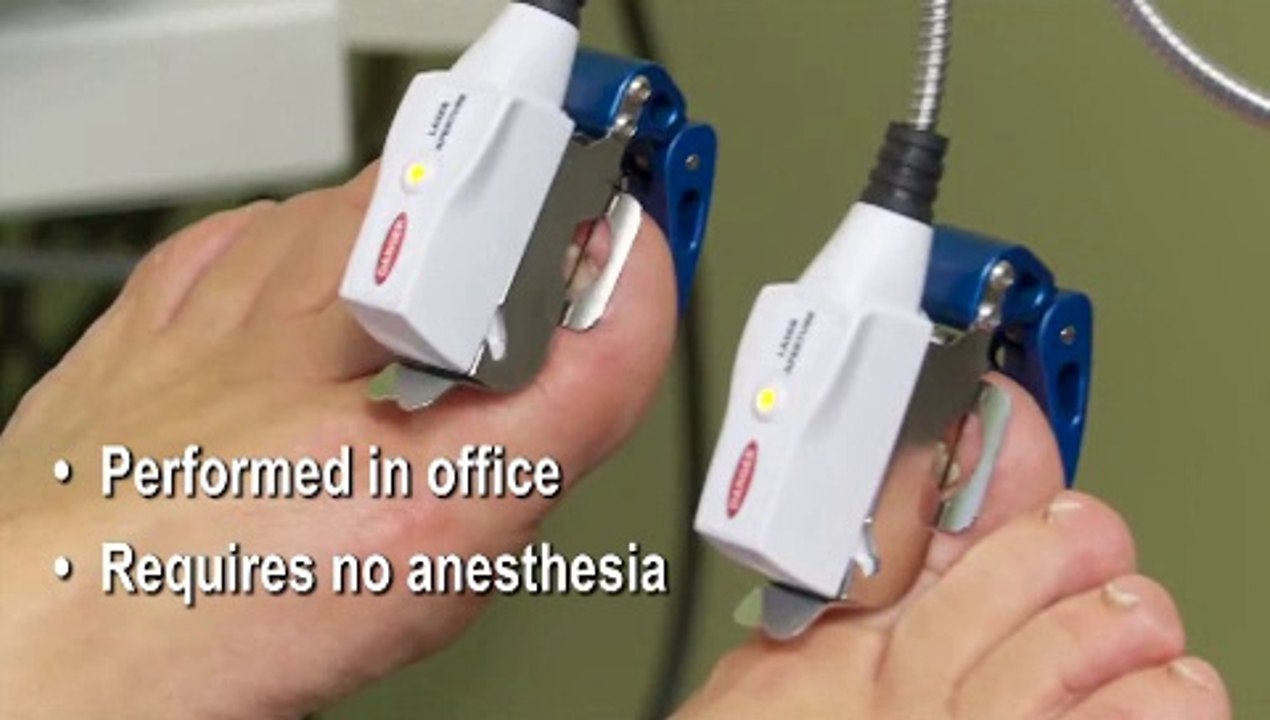 Newington, Glastonbury and Kensington, CT - Laser for Fungal Toenails - Podiatrist