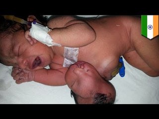 Parasitic twins: Indian baby girl born with an extra head attached to her abdomen