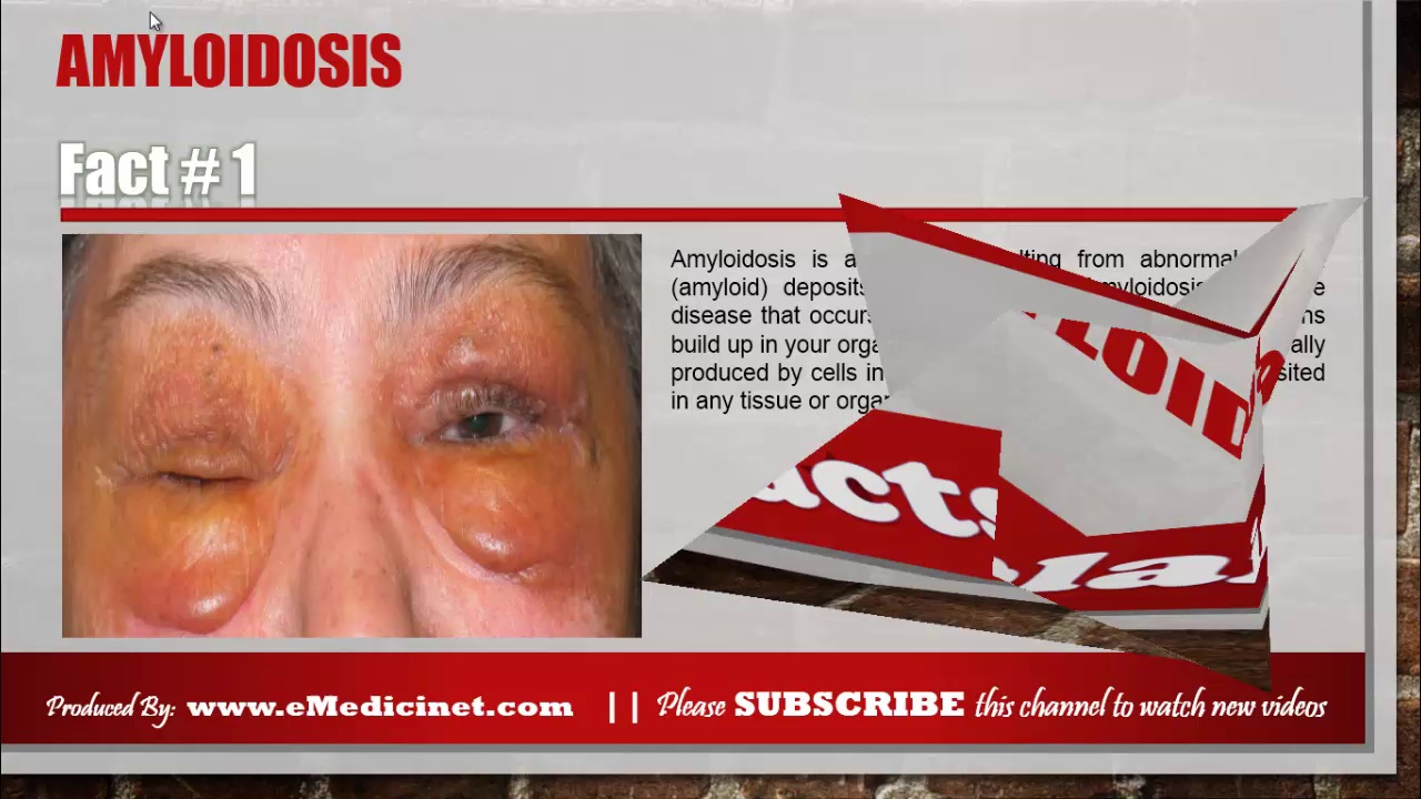 Information about Amyloidosis