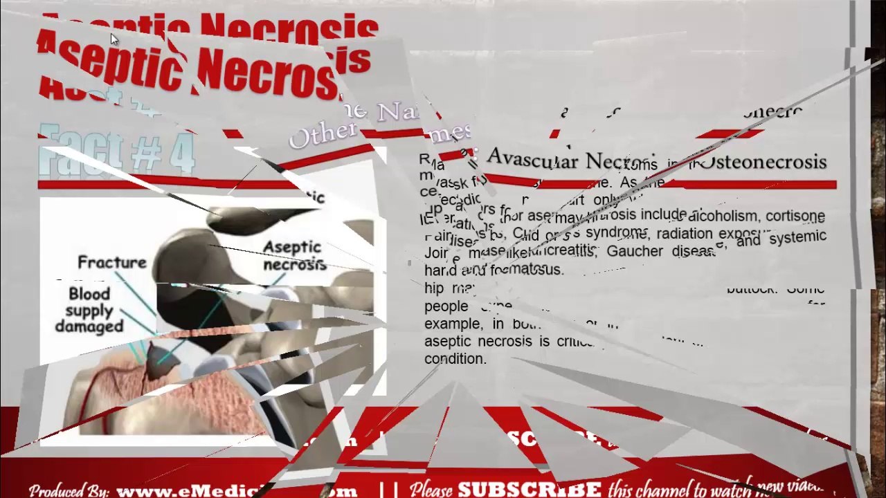 Information about Aseptic Necrosis