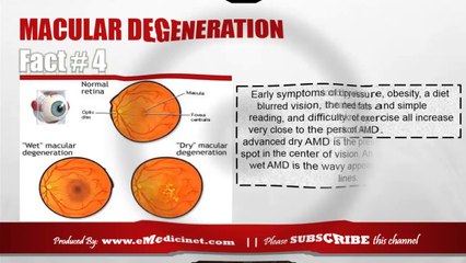 Macular Degeneration