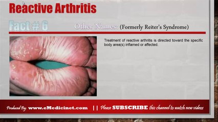 Reactive Arthritis