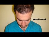 Cheap or affordable fue hair transplant in pakistan ,Ubaid ,USA