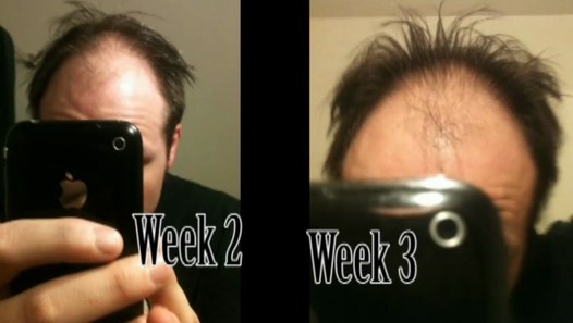 how long does minoxidil work for you