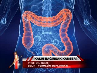 kalın bağırsak kanseri 02 41