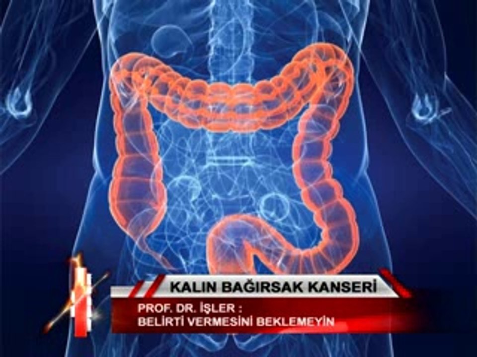 kalın bağırsak kanseri 02 41