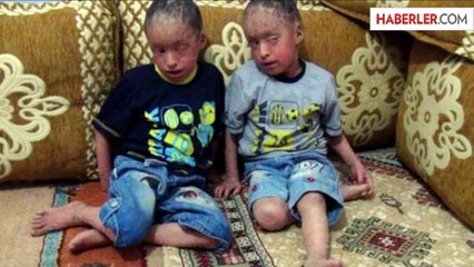 İkiz Çocuklar Dikilen Gözlerinin Açılmasını Bekliyor