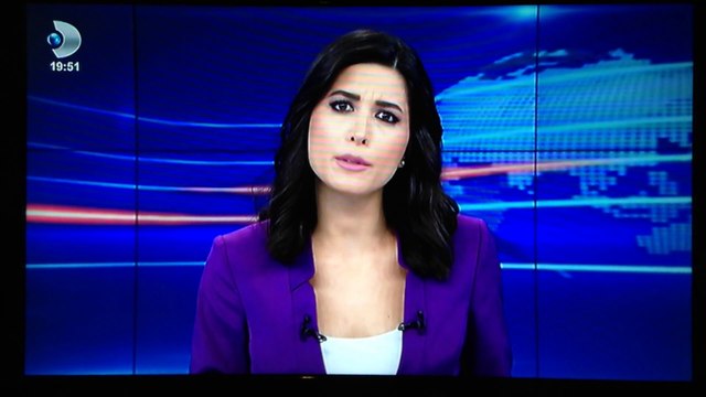 Dr Salih Bürümcek Kanal D Ana Haber'de SOFIA TomoSonografi sistemini anlatıyor 16.02.14