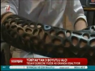 3 Boyutlu Alçı ile İyileşme Süreci Hızlanıyor- A Haber-Akşam Ajansı