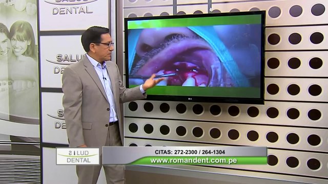 Salud Dental: todo sobre el fracaso de los implantes dentales