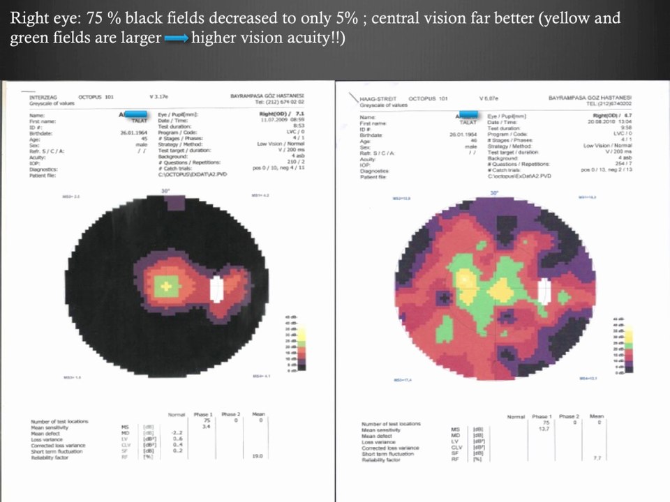 4th Medical Test Results of Retinitis Pigmentosa Patients Treatment - Firatli Clinic