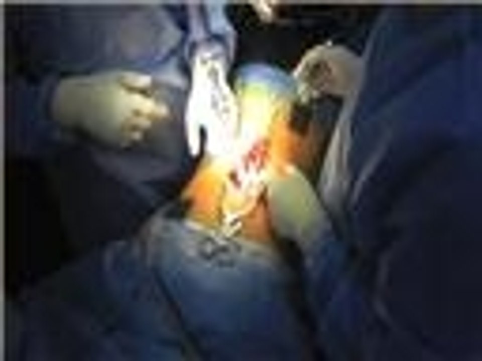 استئصال فقرةكاملة مصابة بالسرطان بالأردن