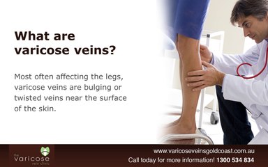 How To Prevent Varicose Veins in Winter