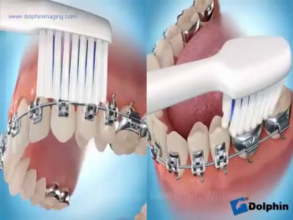 Diş Teli Nasıl Takılır ?