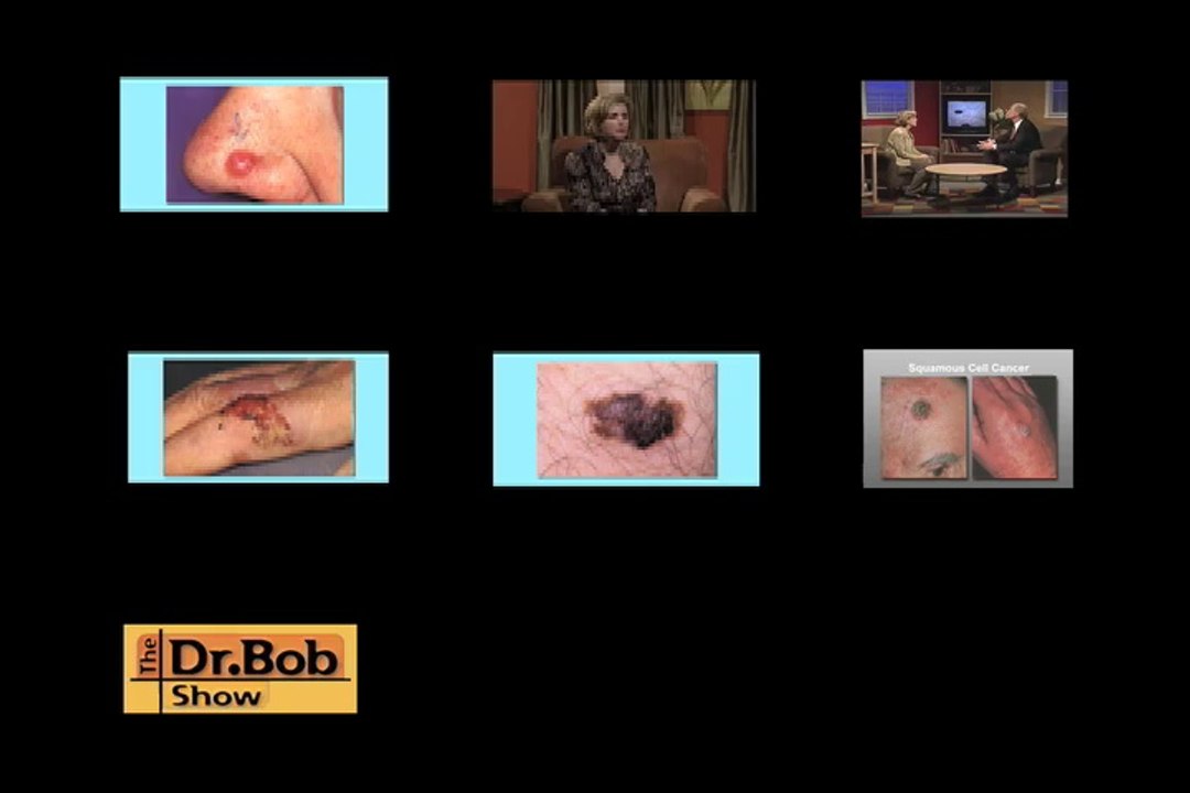 Actinic Keratosis (Precancerous Skin Cancer)