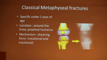 Imaging Evaluation Of Child Abuse - Liora Kornreich - Tuesday 28th January 2014 - Part 2