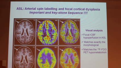 Morphological Imaging In Epilepsies - Nathalie Boddaert - Tuesday 28th January - Part 2