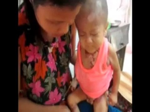 Video - Rơi nước mắt nhìn hai bé bị bỏng rơi từng miếng thịt - Dân trí
