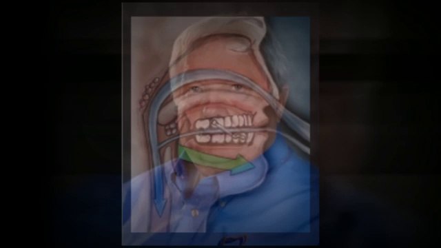 Dental Sleep Apnea Appliance