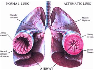 Astım hastalığında tedavi yöntemi / demet kaytan ile sağlıklı yaşam