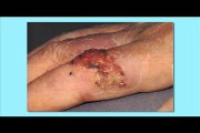 Squamous Cell Carcinoma (Skin Cancer)