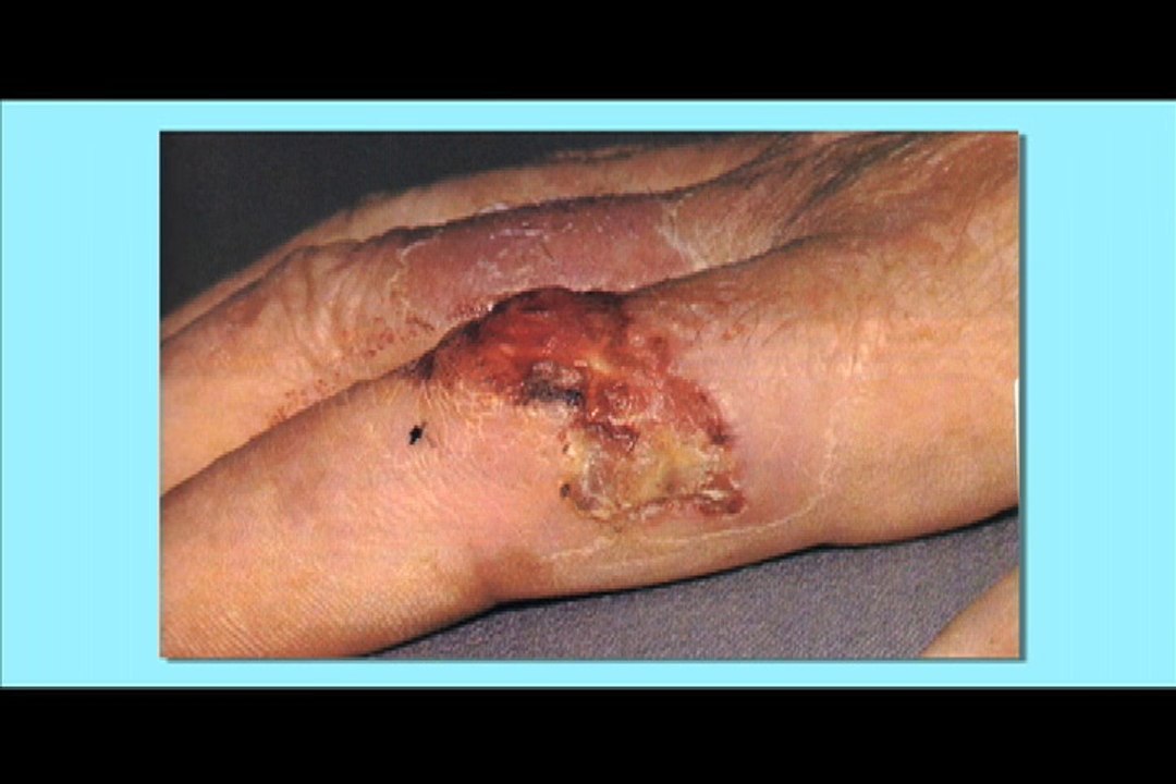Squamous Cell Carcinoma (Skin Cancer)