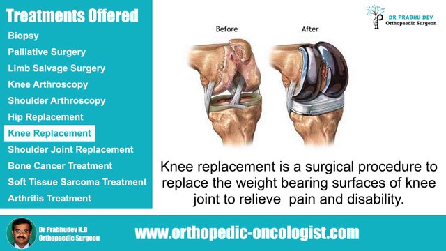 Orthopedic Surgeon in Bangalore | Arthritis treatment in Bangalore