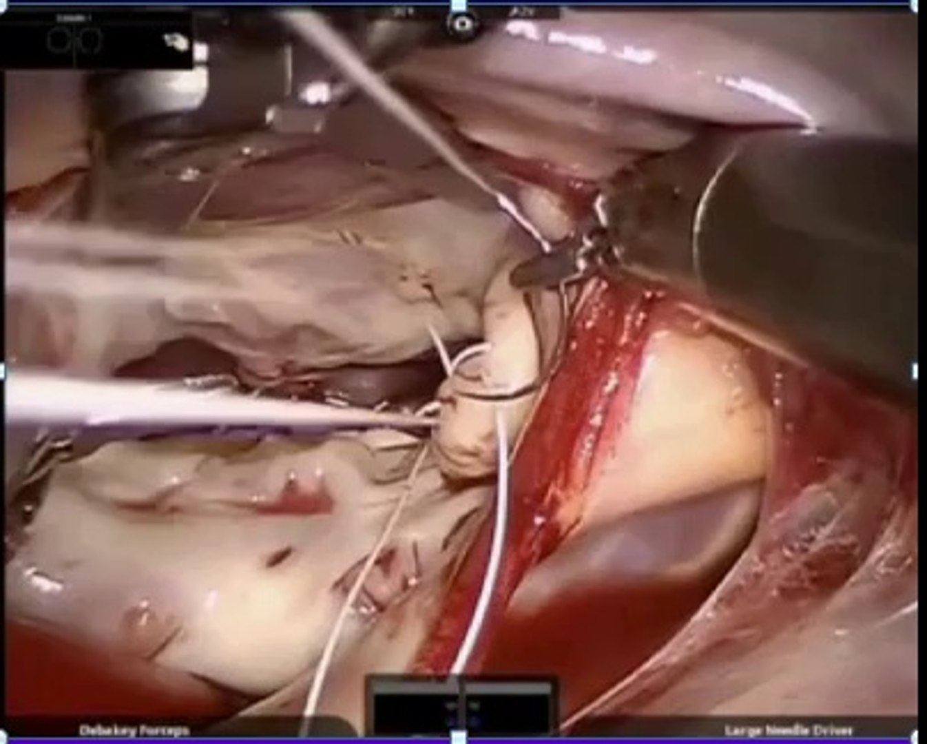 ⁣Learn  more about mitral valve repair recovery