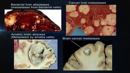 Atavistic Chemotherapy | Immunotherapy | Cancer Treatments | Atavism