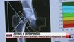 Asthma patients more prone to osteoporosis study