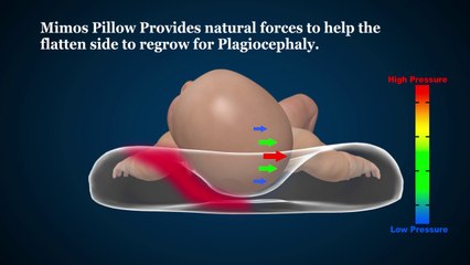 Mimos Baby Pillow - Natural Plagiocephaly treatment, clinically test effective and CE approved Medical Device