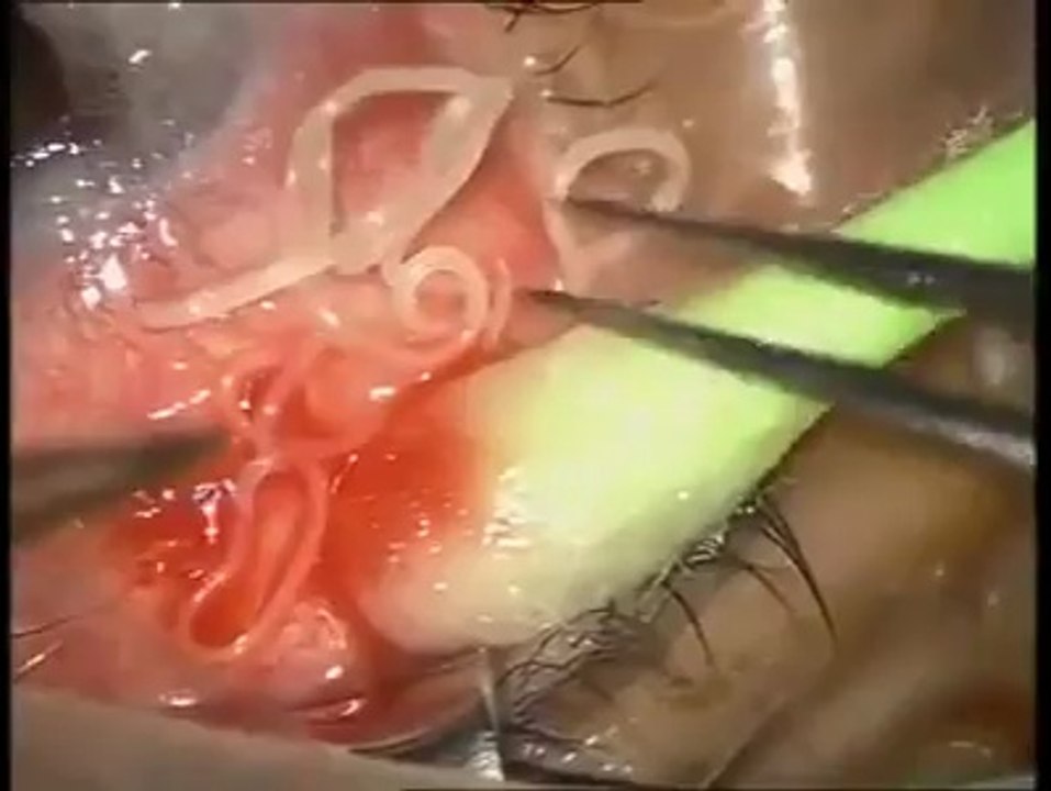 Worm Cought in Eye