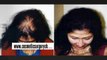 alopecia treatment - balding - baldness - Dr. Ari Arumugam - Cosmetic Surgery Chennai - Dr. Ari Chennai