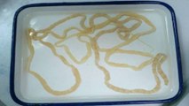 Woman Discovers 8ft Tapeworm Living Inside Her