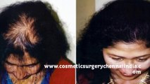 hair fall - hair fall solution - hair fall treatment - Dr. Ari Arumugam - Hari Transplant Chennai - 