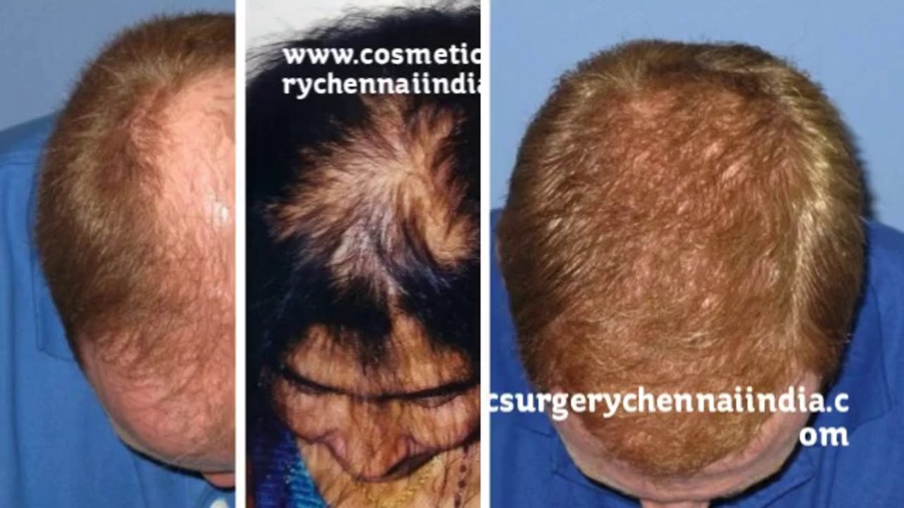 alopecia areata - alopecia treatment - balding - Plastic Surgery Chennai - Dr. Ari Chennai - Dr. Ari Arumugam