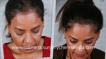 hairloss - home remedies for hair growth - how to grow hair - Hari Transplant Chennai - Dr. Ari Chennai - Dr. Ari Arumugam