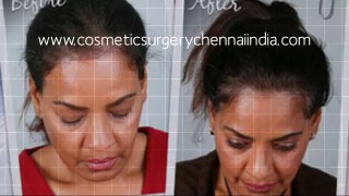 scalp med - shampoo for hair loss - thinning hair - Hari Loss Treatment Chennai - Dr. Ari Chennai - Dr. Ari Arumugam