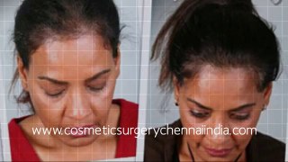 hair treatment - hair weaving - hairloss - Plastic Surgery Chennai - Dr. Ari Chennai - Dr. Ari Arumugam