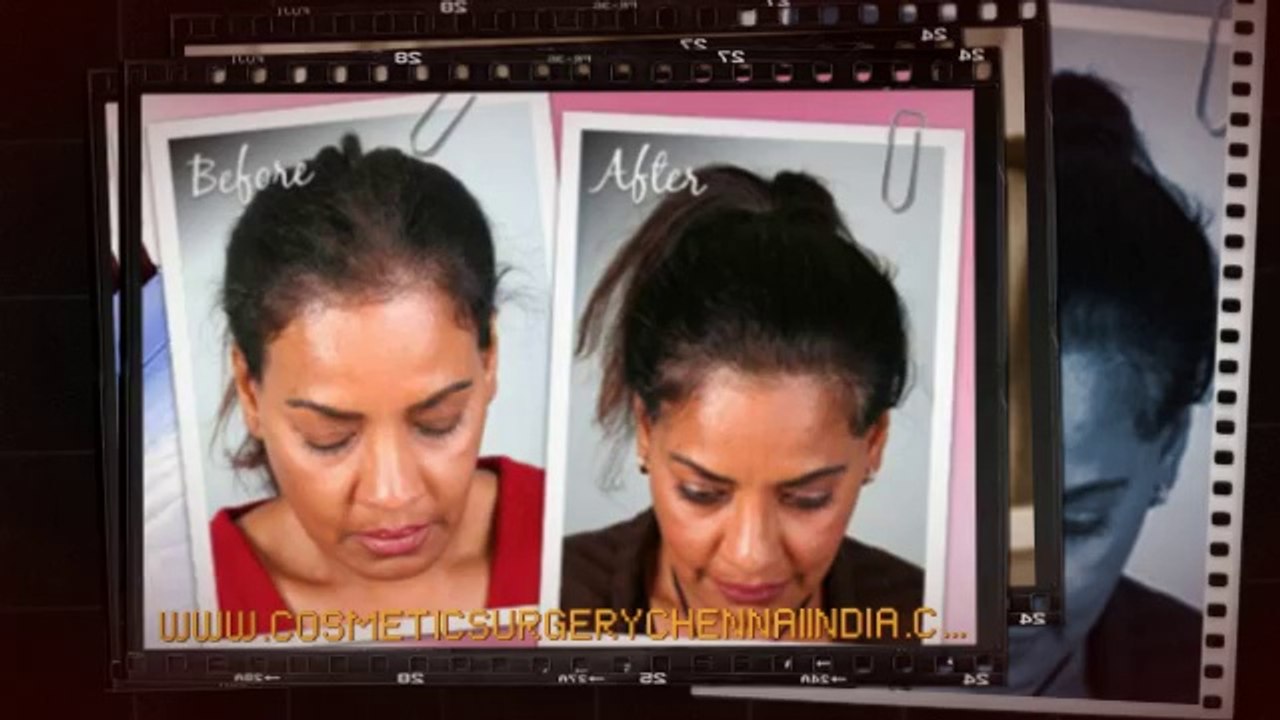 how to stop hair loss - laser comb - male pattern baldness - Dr. Ari Chennai - Dr. Ari Arumugam - Cosmetic Surgery Chennai