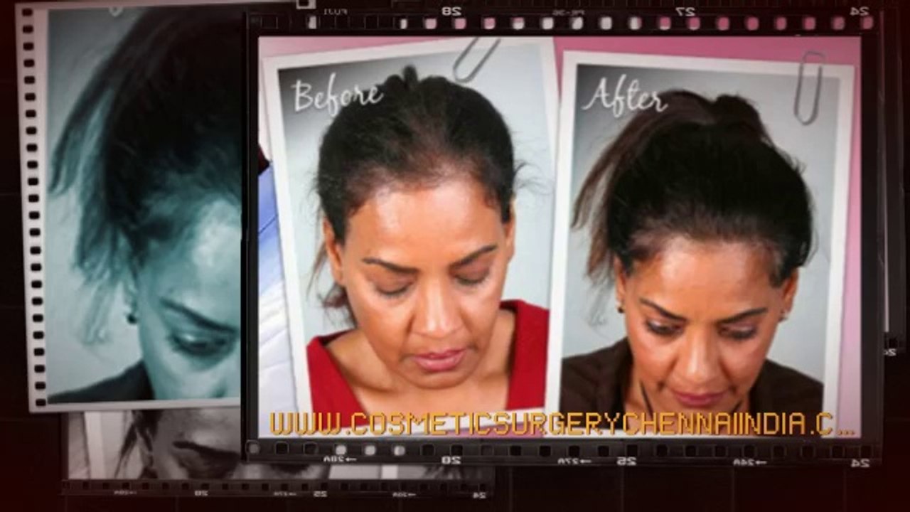 hair loss - hair loss causes - hair loss in women - Dr. Ari Arumugam - Hari Loss Treatment Chennai - Dr. Ari Chennai