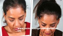 hair loss shampoo - hair loss treatment - hair loss women - Dr. Ari Chennai - Dr. Ari Arumugam - Pla